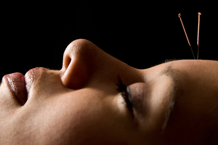 Facial Acupuncture at Southwell Acupuncture Clinic