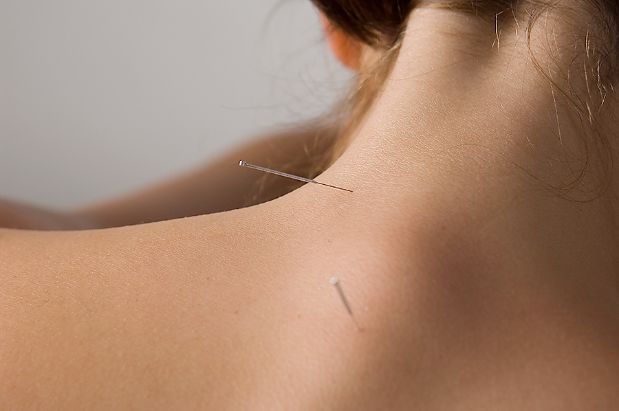 Acupuncture-Treatment-Neck-Pain