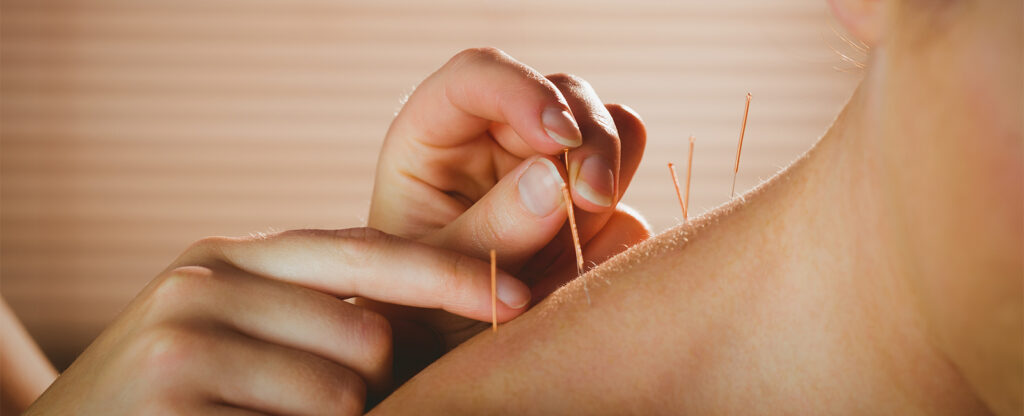 Fine Acupuncture Needles