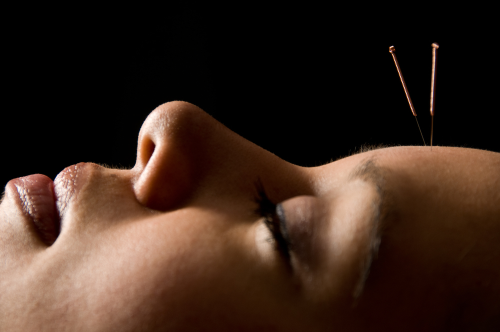 Acupuncture for you
